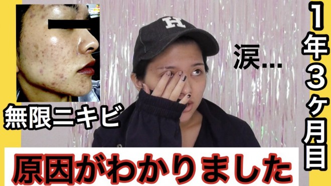 顔中ニキビ0個 ギャルモデルの壮絶な肌荒れ 告白動画 に反響 やっと解放された Oricon News