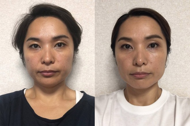 y̌beforeijafteriEjz1TԂŖ炩ȕωBڂXbLdɁApオiMES40΁j