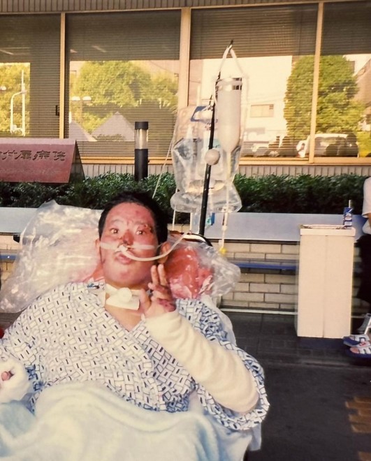 �S�g��40���ɂ₯�ǂ𕉂����������_�����M����