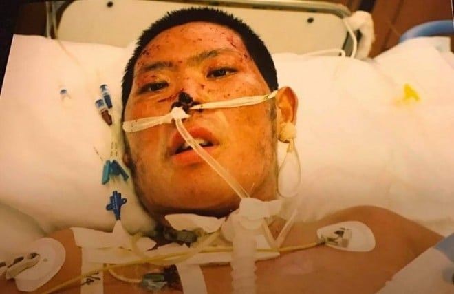 �S�g��40���ɂ₯�ǂ𕉂����������_�����M����