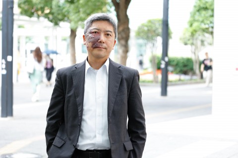 顔面に“赤アザ”を持つ男性　進学、就職、結婚を経て変化した外見への向き合い「環境が変われば気持ちも変わるんだ」
