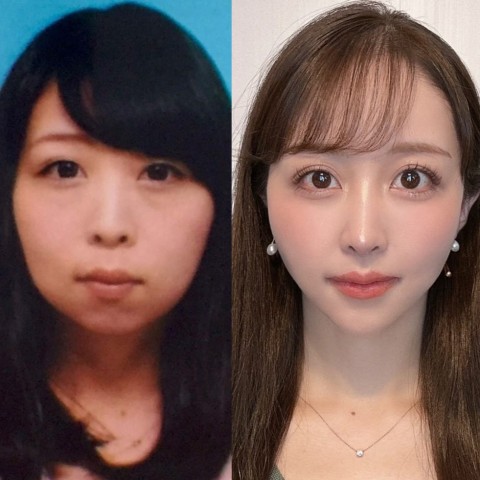 【整形美女】“お金で手に入れた見た目”はズルい？…1300万課金した女性が語る美の価値観「包帯を取っても美しい自分はいなかった」