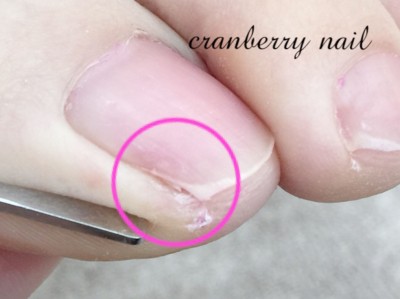 間違っている人多数 正しい足の爪の切り方を知っていますか Oricon News