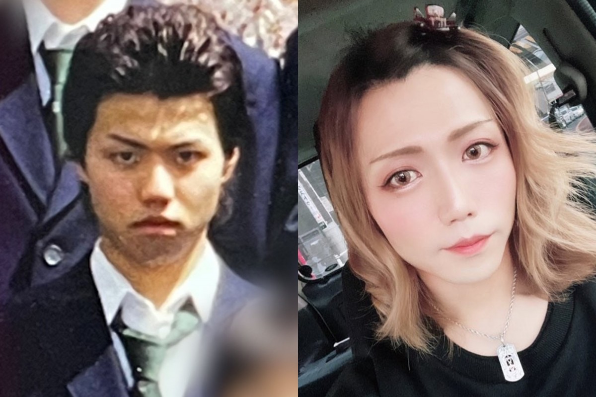 アトピー 有名人