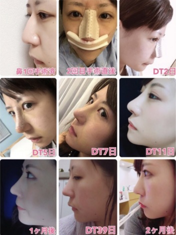 鼻の変化（画像：本人提供） 