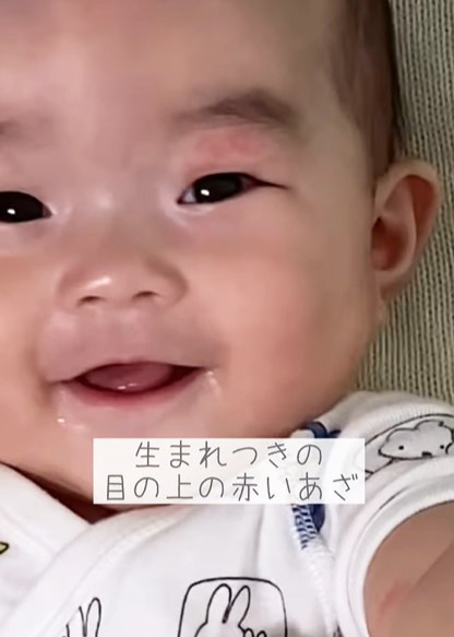 娘の顔に“生まれつきのアザ”…8ヵ月間の記録とママの願いに275万再生